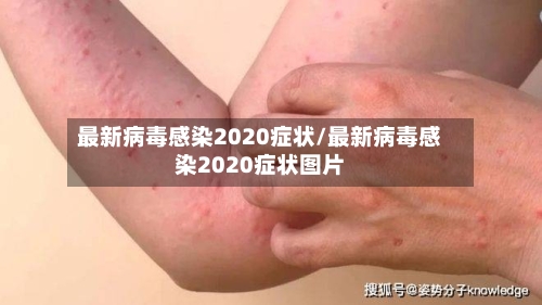 最新病毒感染2020症状/最新病毒感染2020症状图片-第2张图片